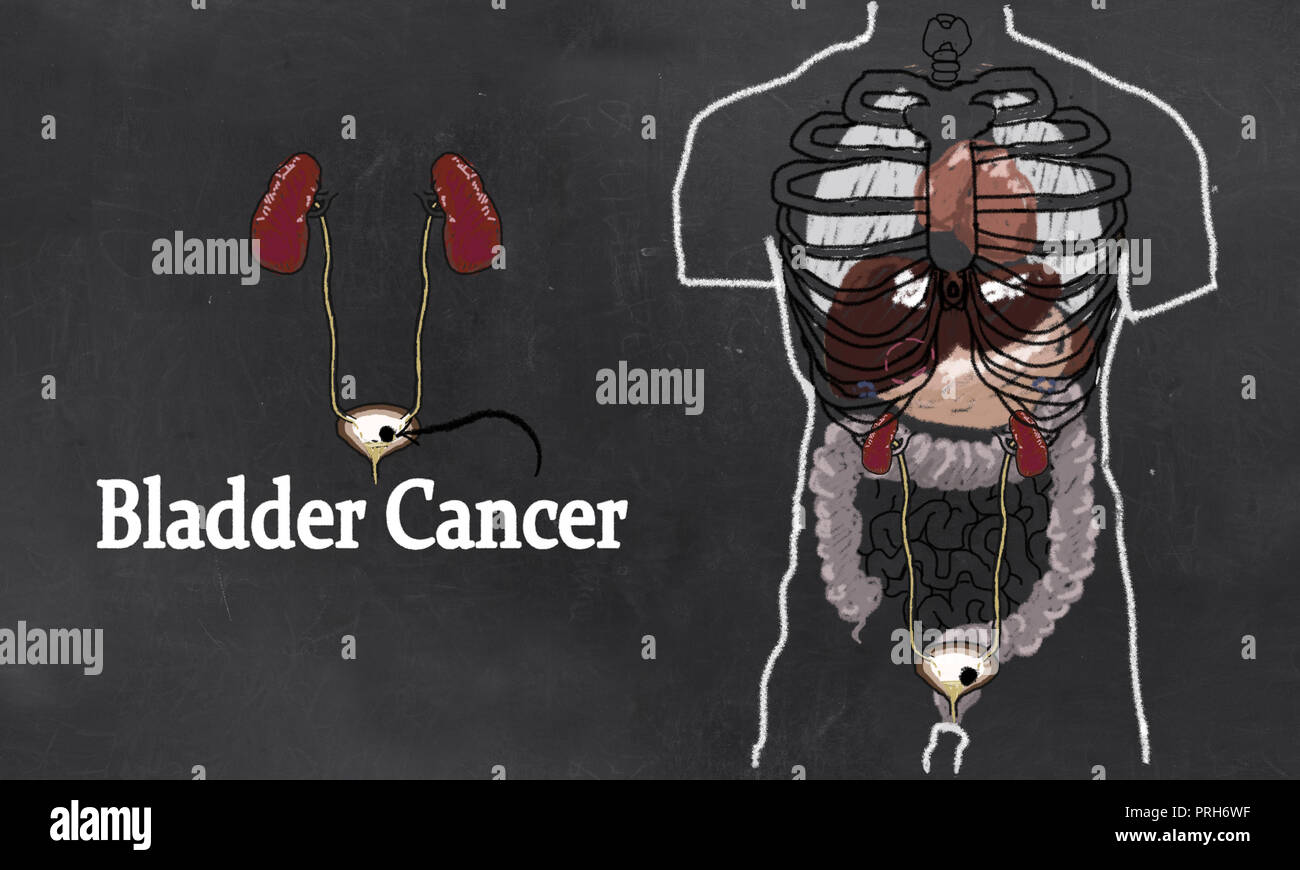 Bladder Cancer Anatomy Illustration with Urinary Tract System. Simple