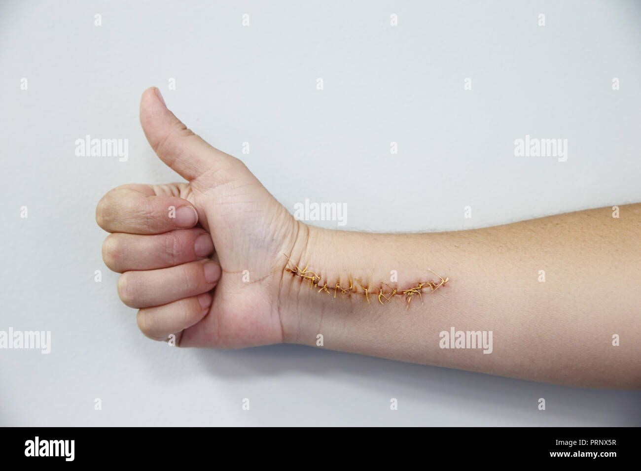 Humand hand hurt with a big scar with a lot of stitches. Horizontal shot Stock Photo