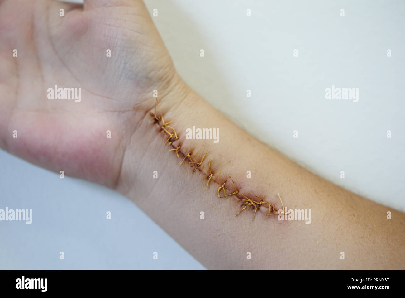 Humand hand hurt with a big scar with a lot of stitches. Horizontal shot Stock Photo