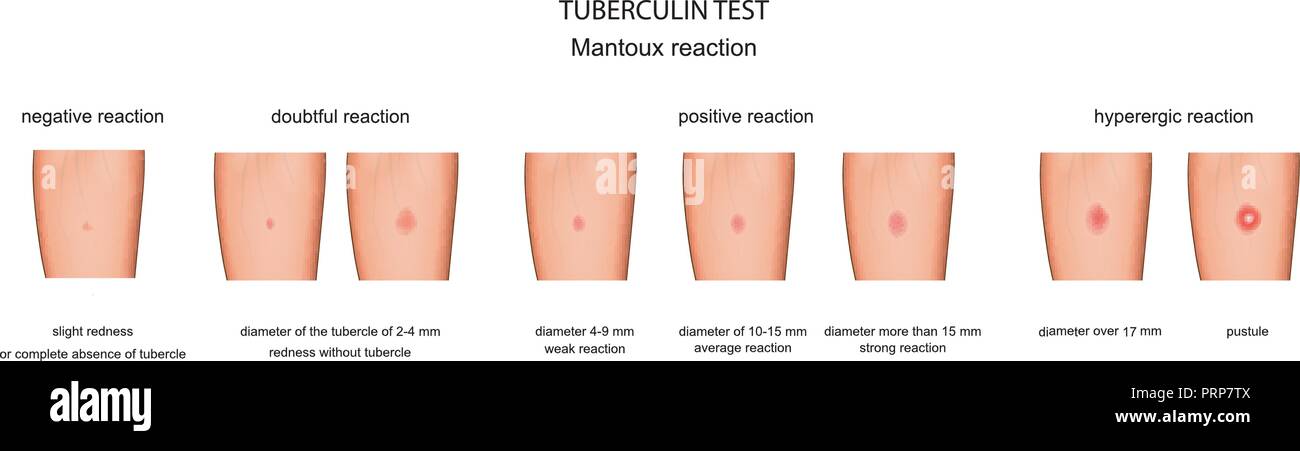 vector illustration of the assessment of reaction to a Mantoux test Stock Vector