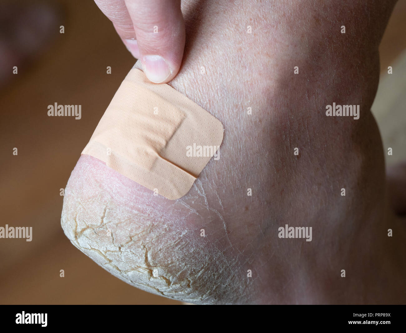 adhesive bandage closes callus on heel close up Stock Photo