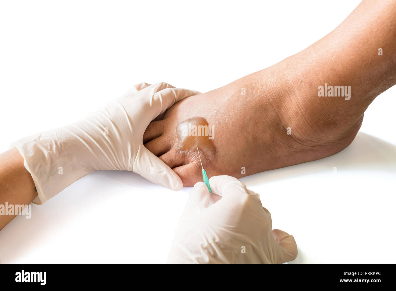 The nurse use the sterilize needle to pierce the scald to drain the