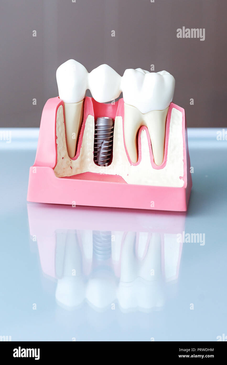 Close up of a Dental implant model. Selective focus. Stock Photo