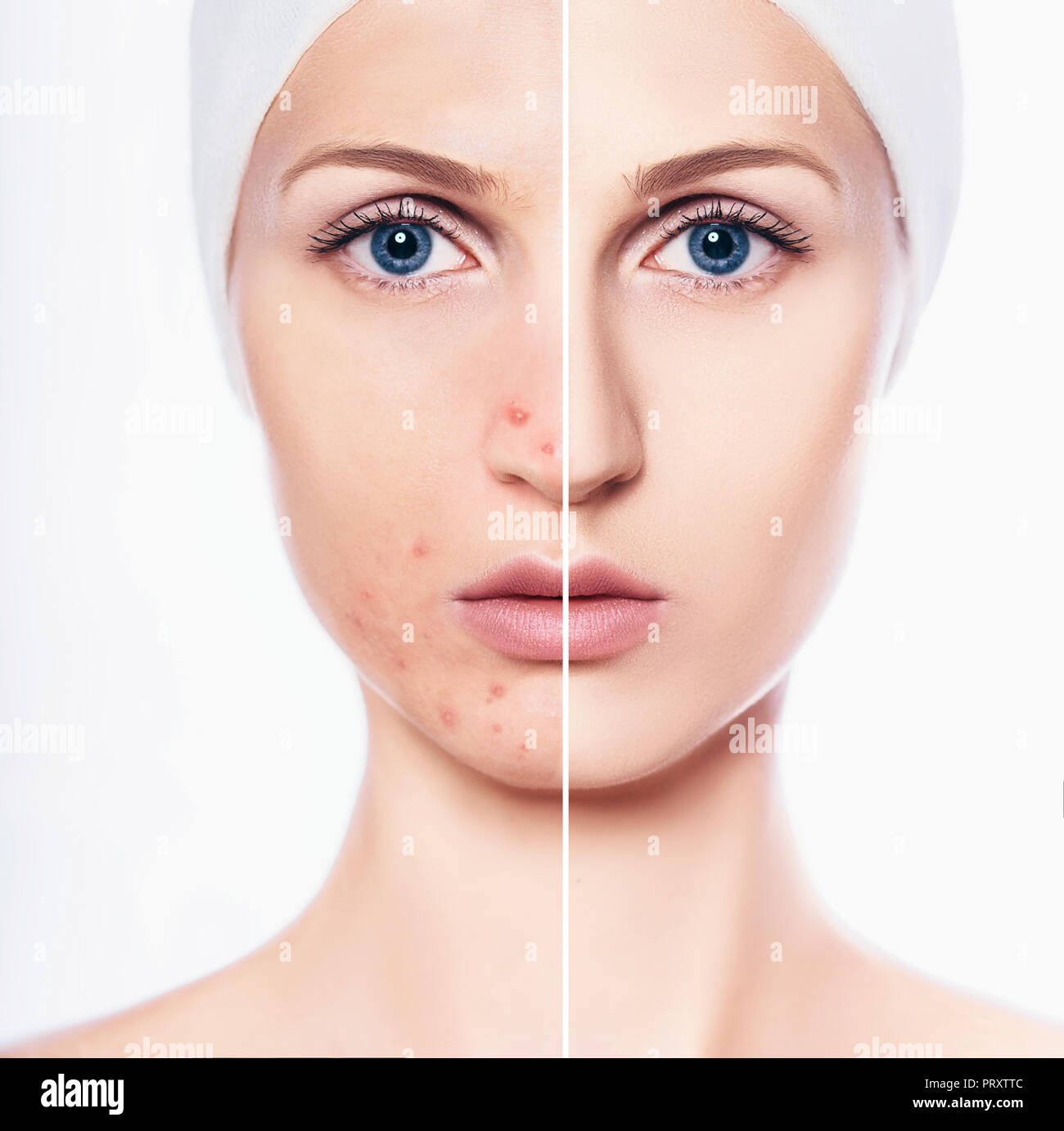 face of beautiful woman with problem acne skin and clear skin Stock Photo