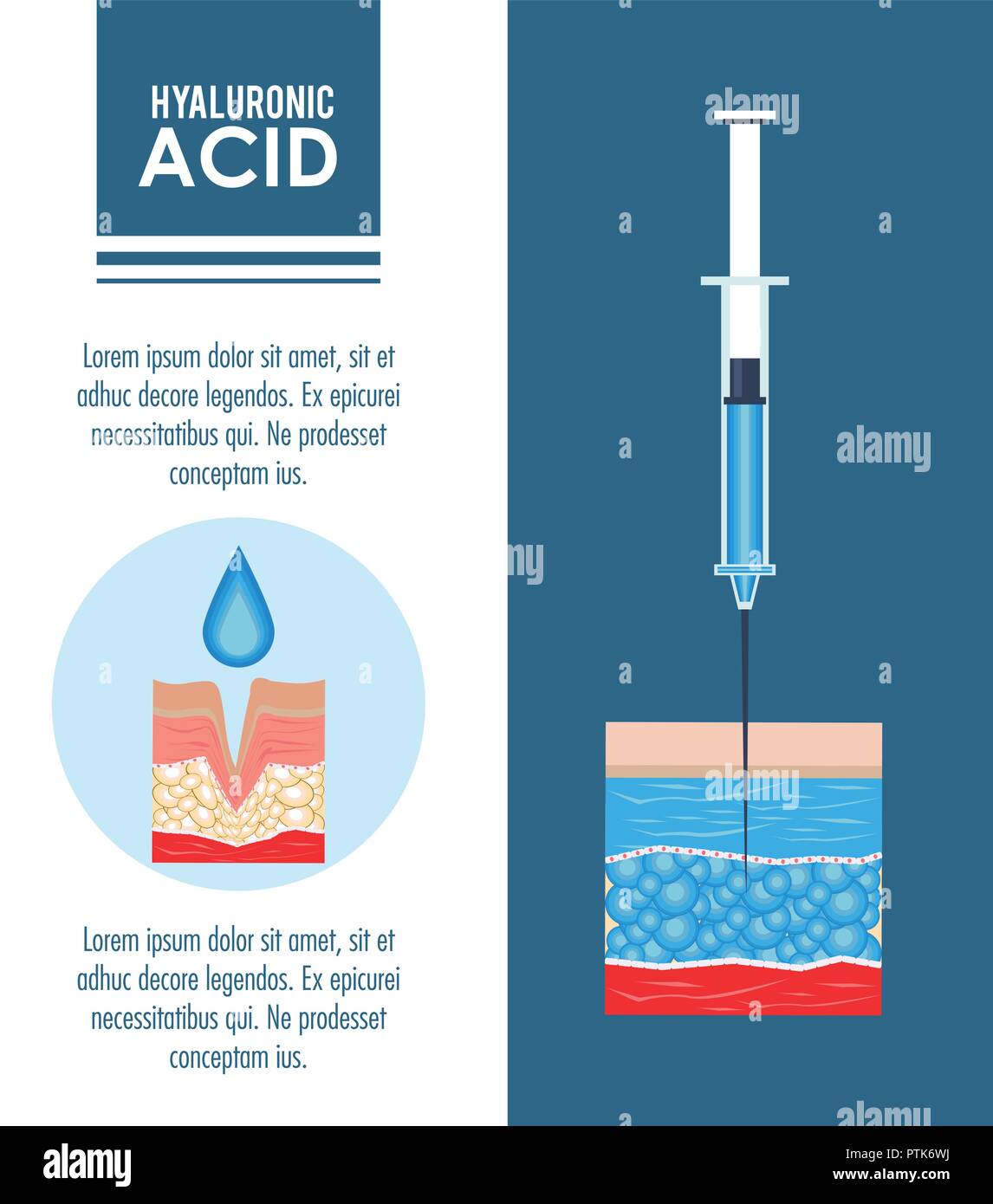 hyaluronic acid filler injection infographic Stock Vector Image & Art