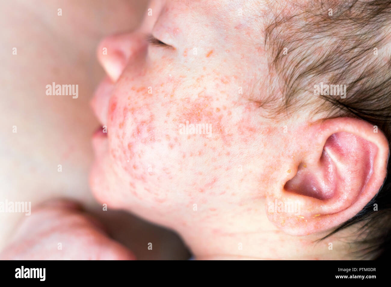 Newborn baby with many red spots caused by neurodermatitis, Poland Stock Photo