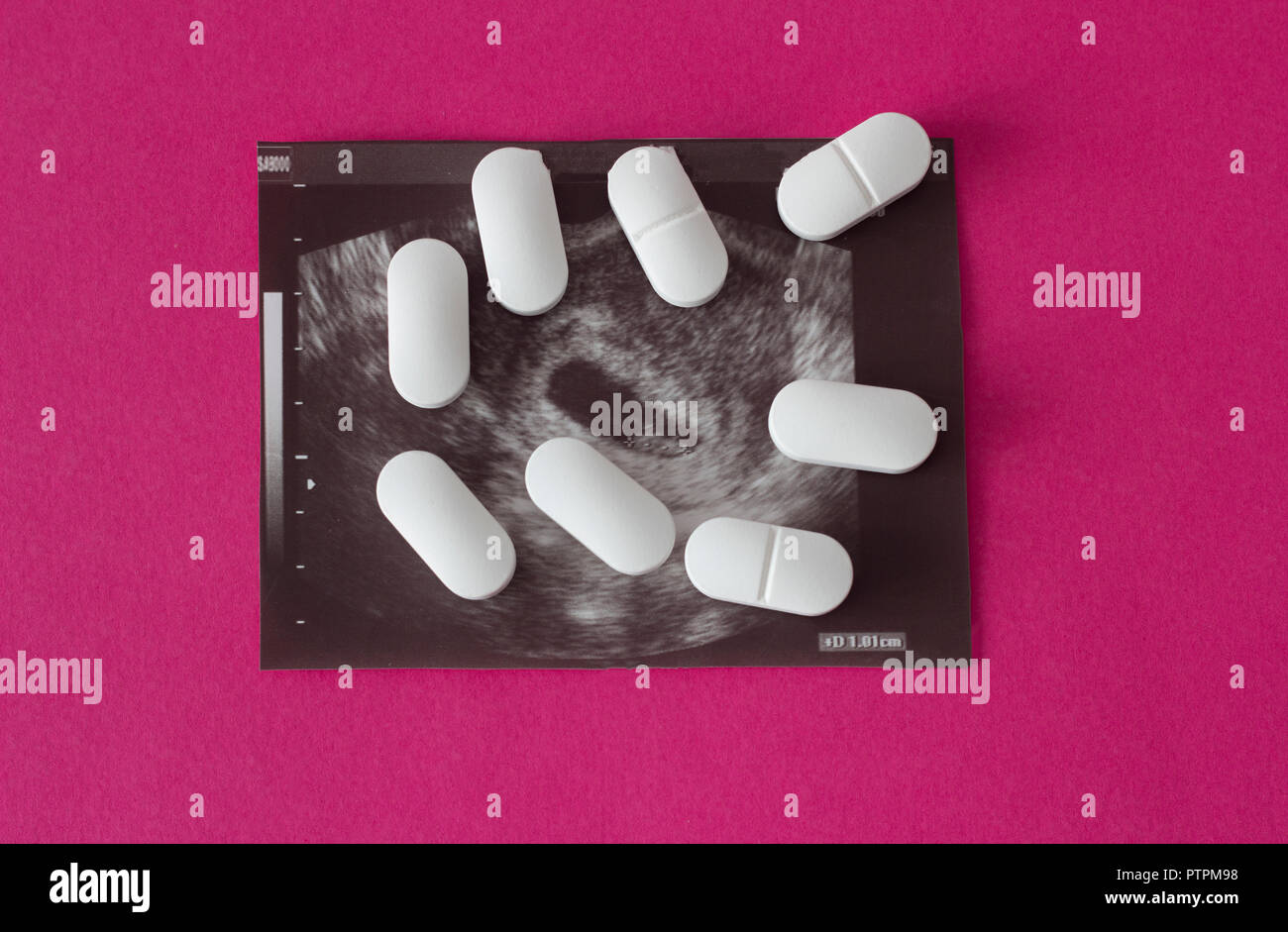 Uzi of pregnancy on a pink background and pills, abortion. Stock Photo