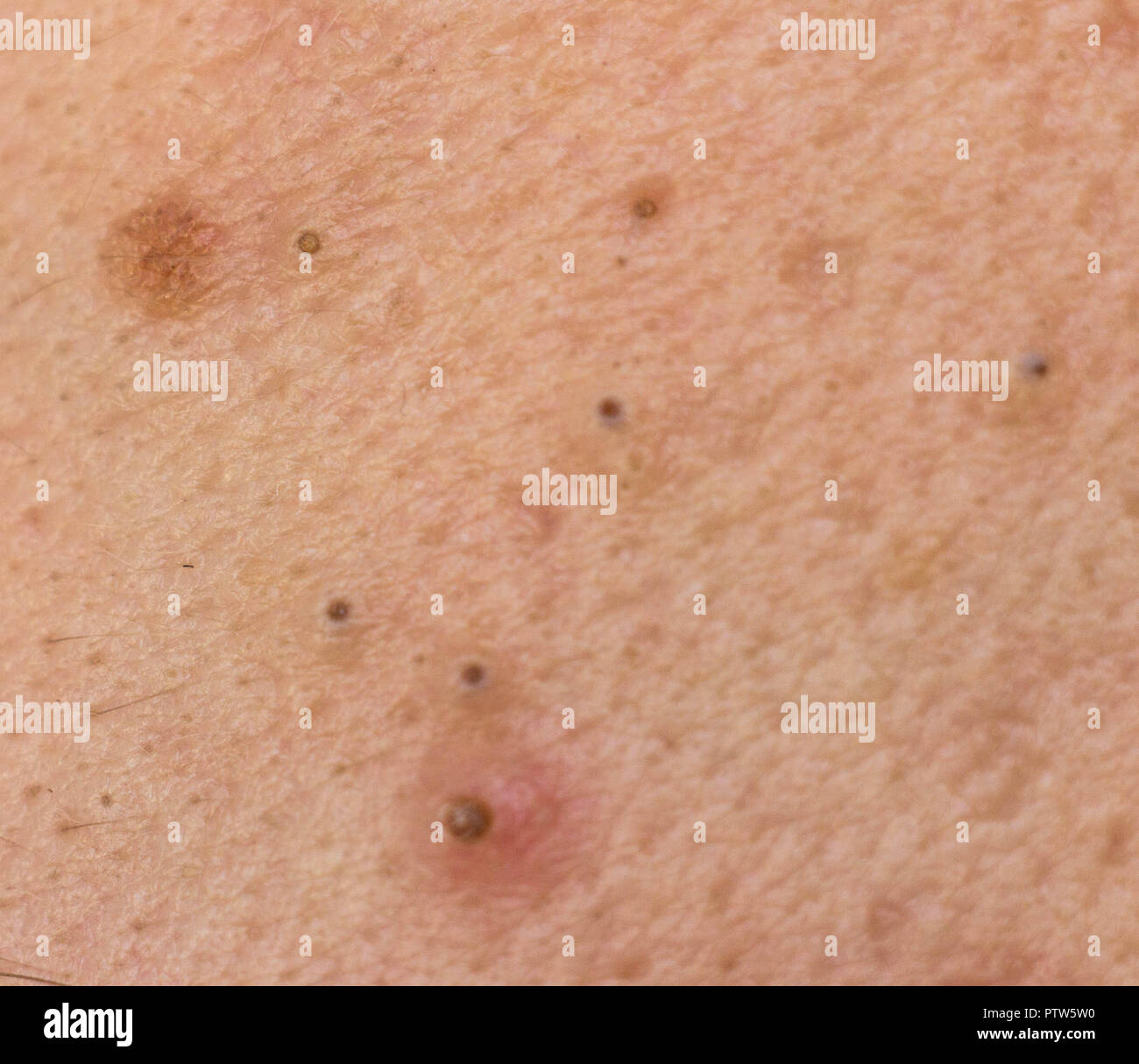 Black dots on face and pimples macro, comedo Stock Photo