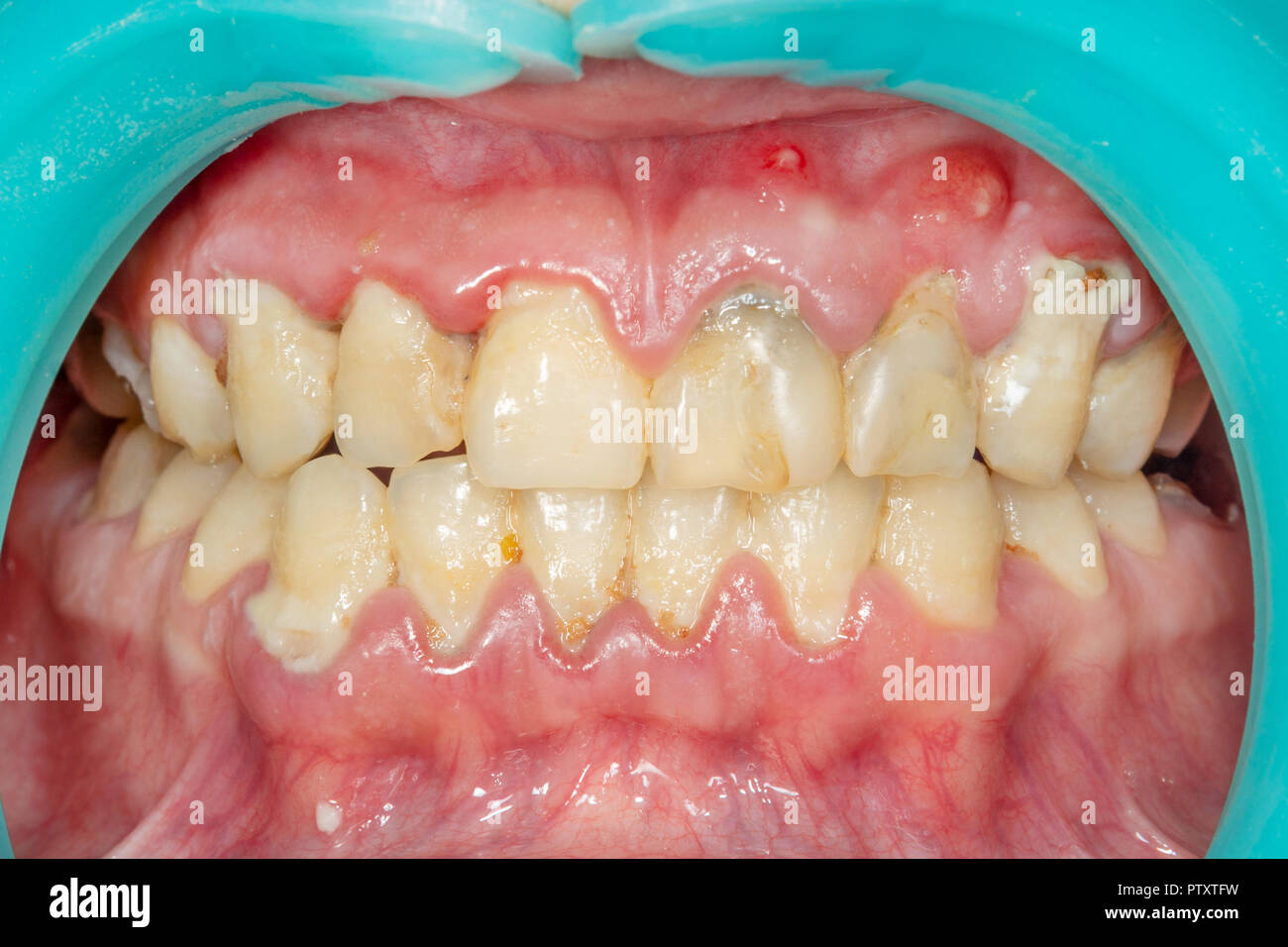 Plaque of the patient, stone. Dentistry treatment of dental plaque, professional oral hygiene. The concept of harm to smoking and cleaning teeth Stock Photo