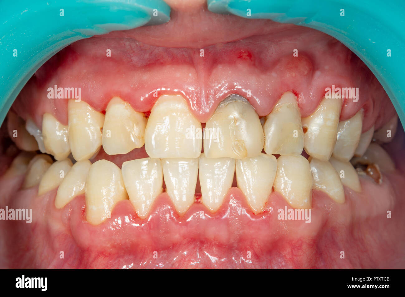 Plaque of the patient, stone. Dentistry treatment of dental plaque