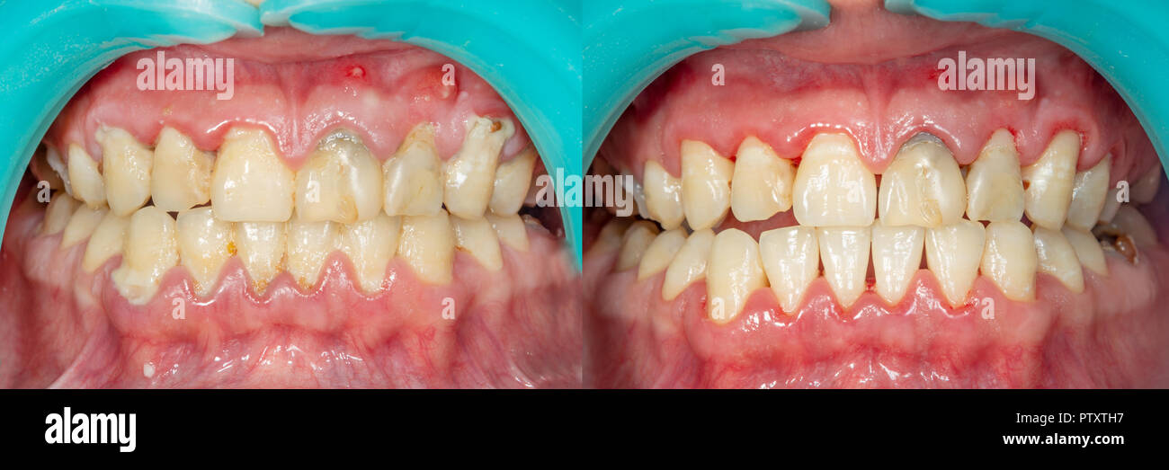 Plaque of the patient, stone. Dentistry treatment of dental plaque