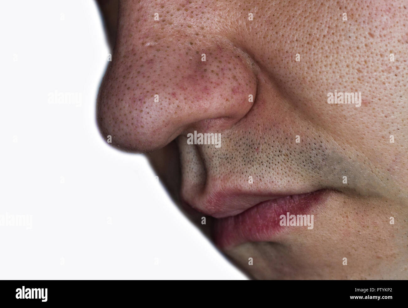 Black dots, blackheads, on the man's face, close-up Stock Photo