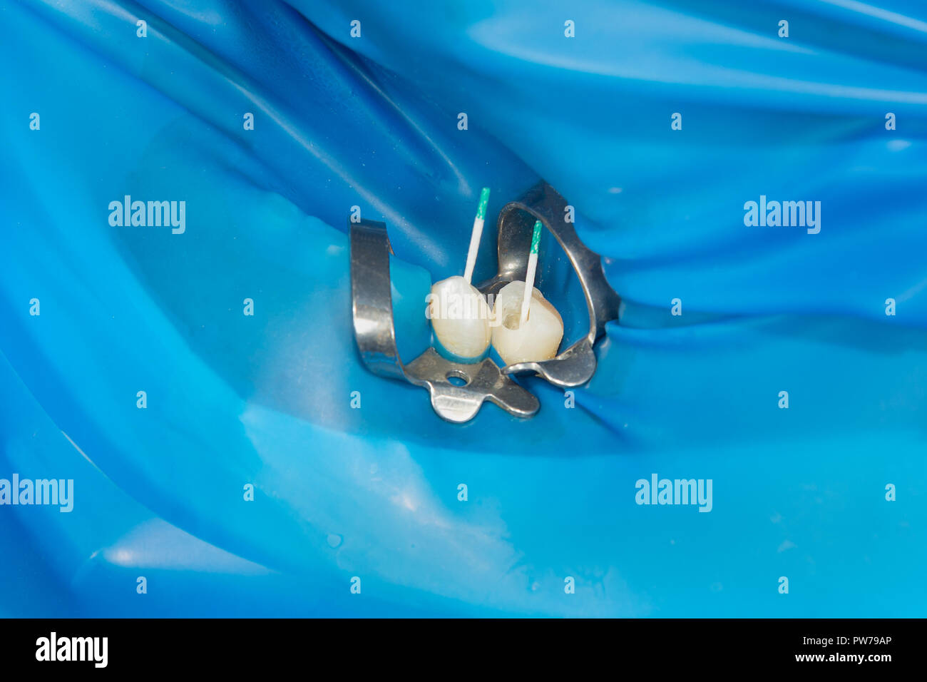 photo endodontic treatment of dental canals in the lower molar