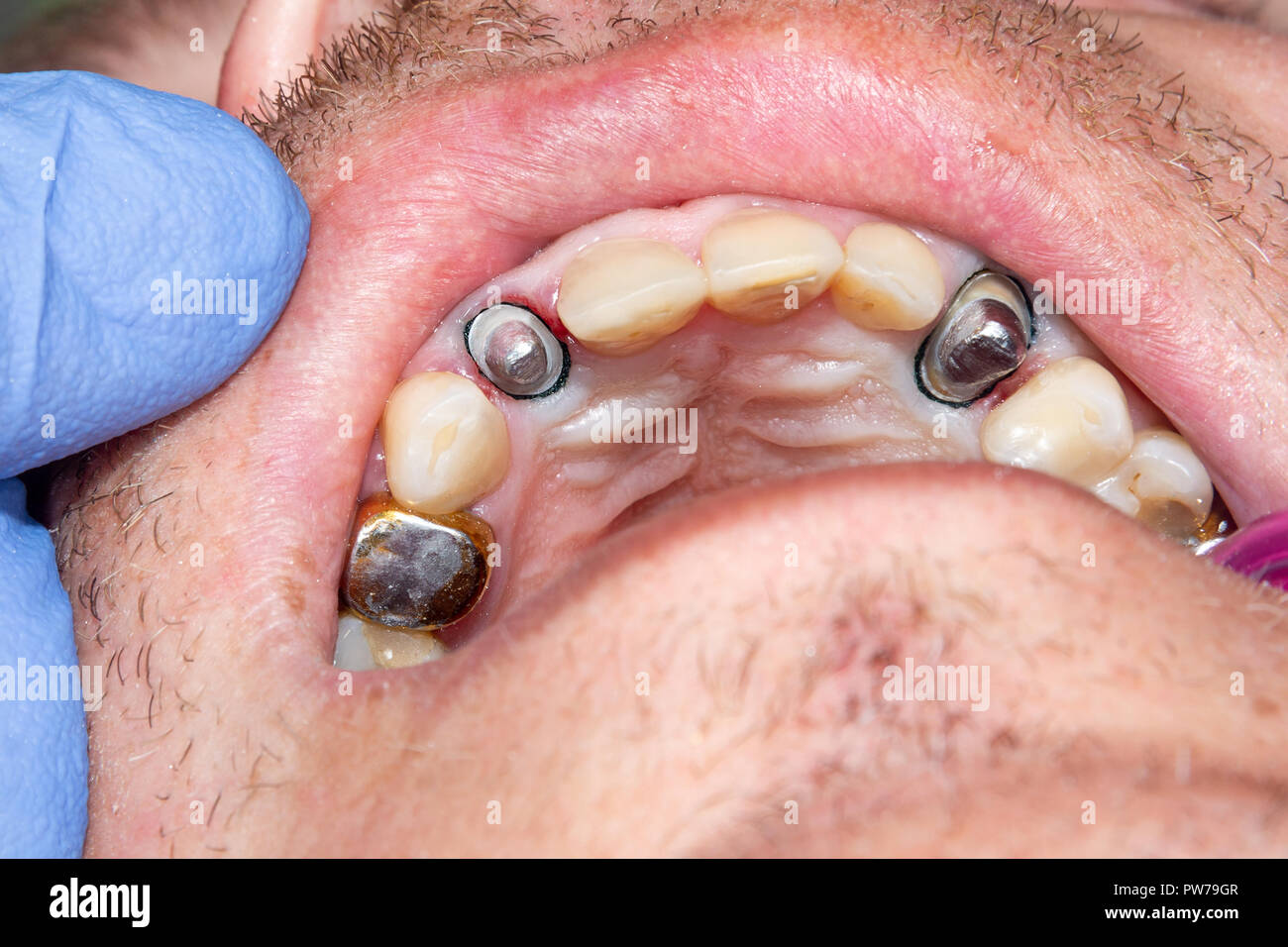 closeup human tooth together with a pin, is prepared by a bur under