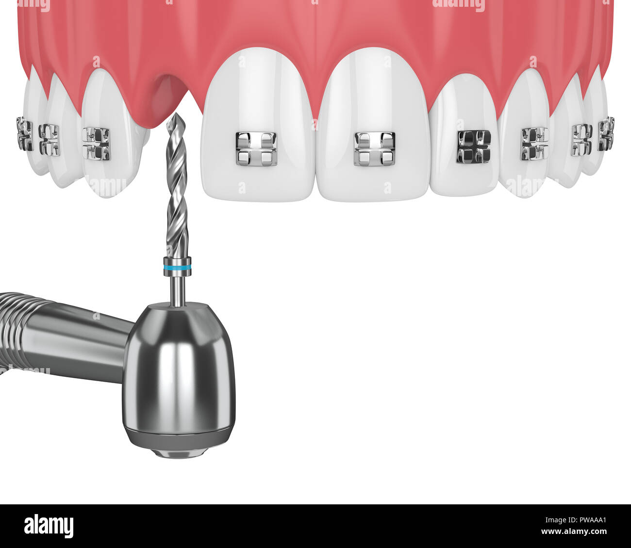 3d render of teeth with orthodontic braces and dental drill
