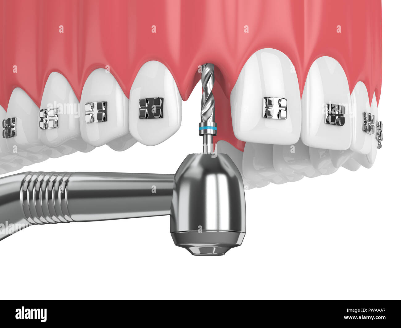 3d render of teeth with orthodontic braces and dental drill ...
