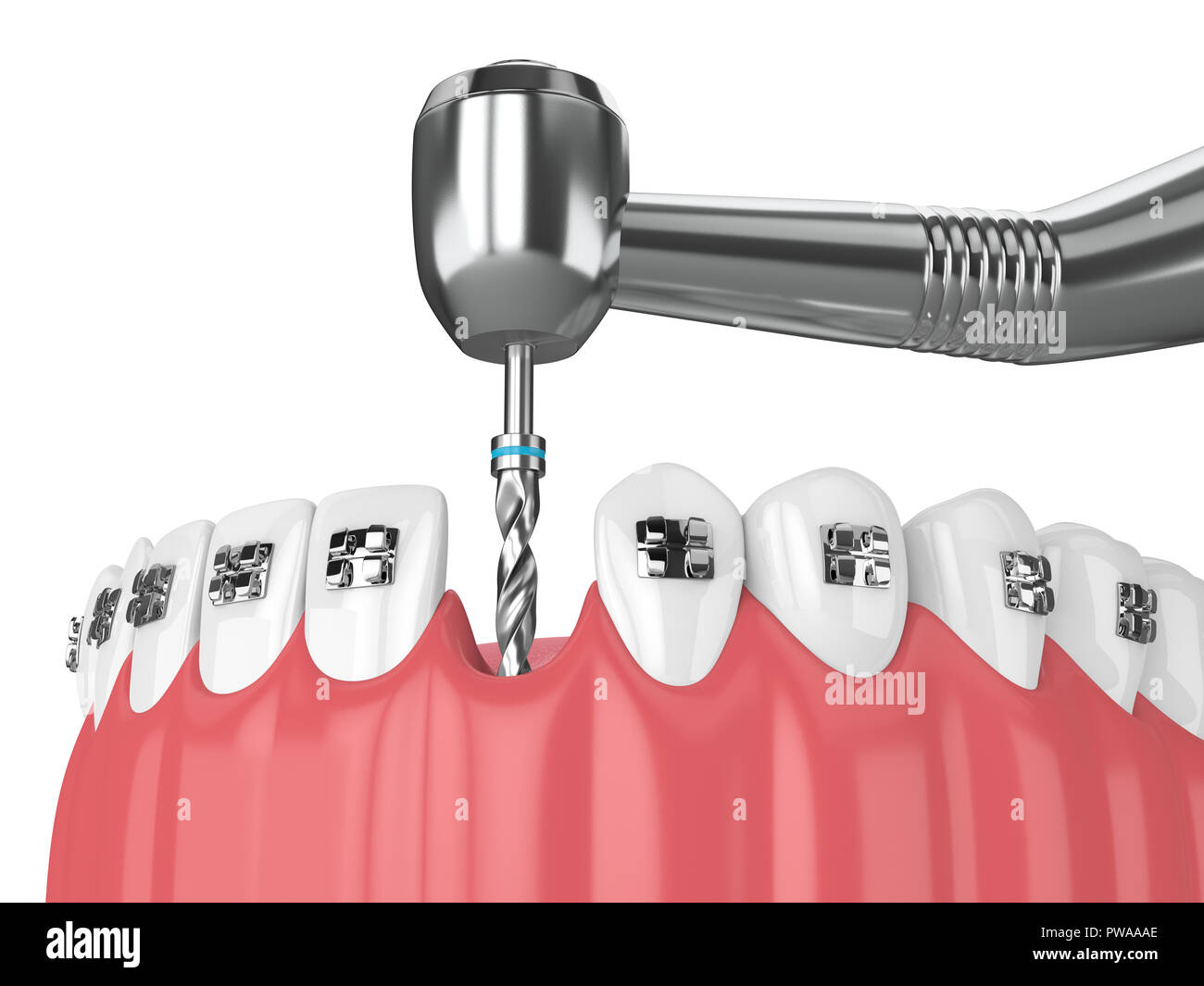 3d render of teeth with orthodontic braces and dental drill ...