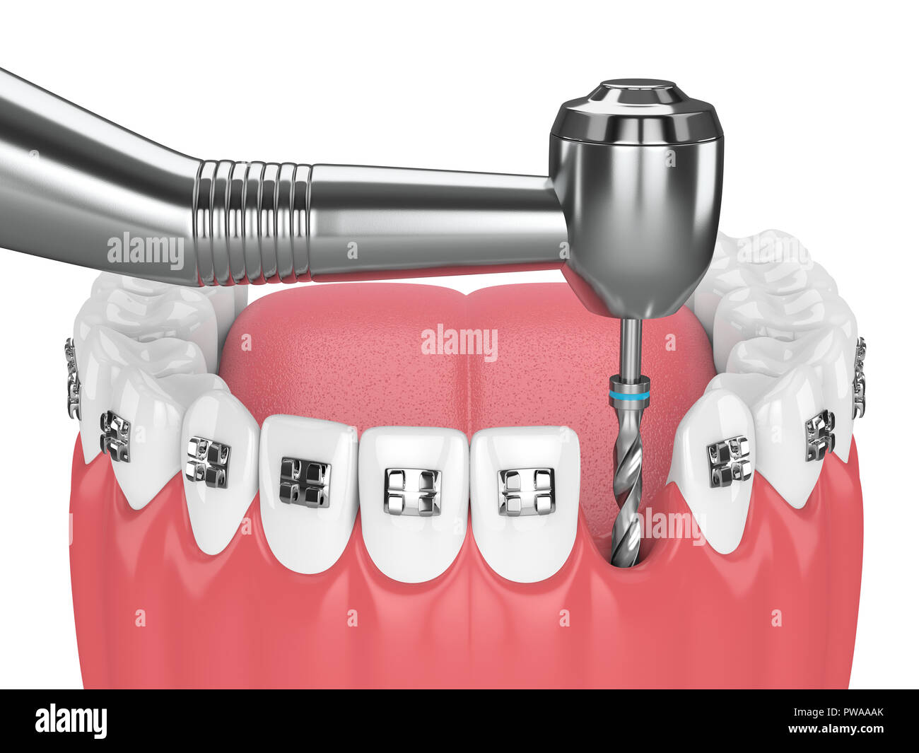 3d render of teeth with orthodontic braces and dental drill ...