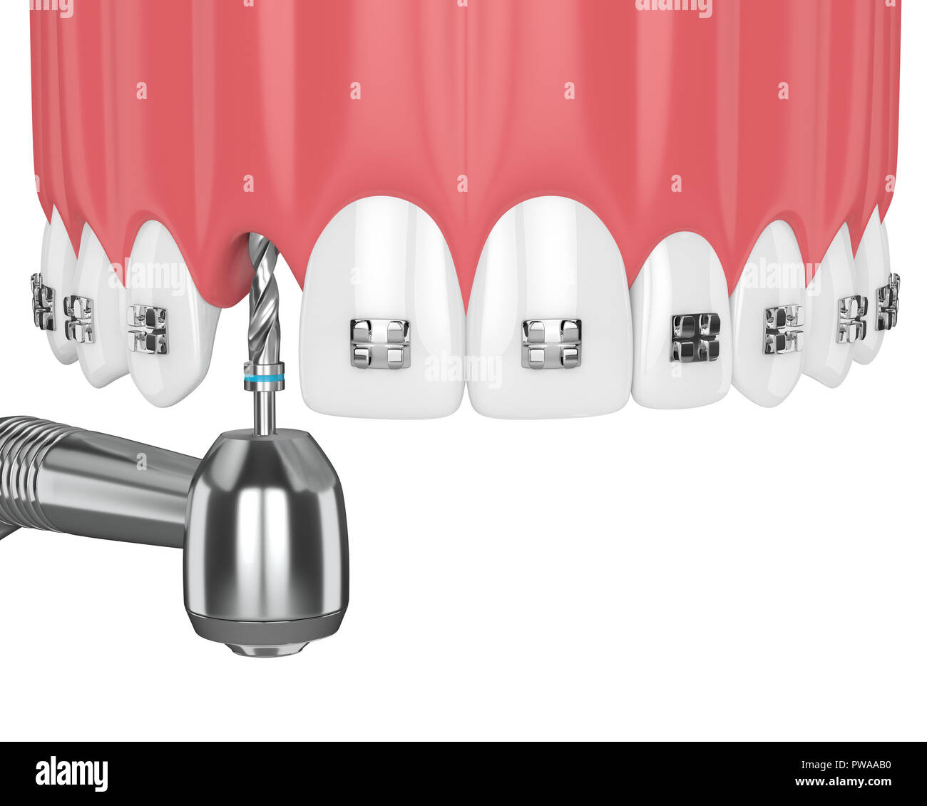 3d render of teeth with orthodontic braces and dental drill ...