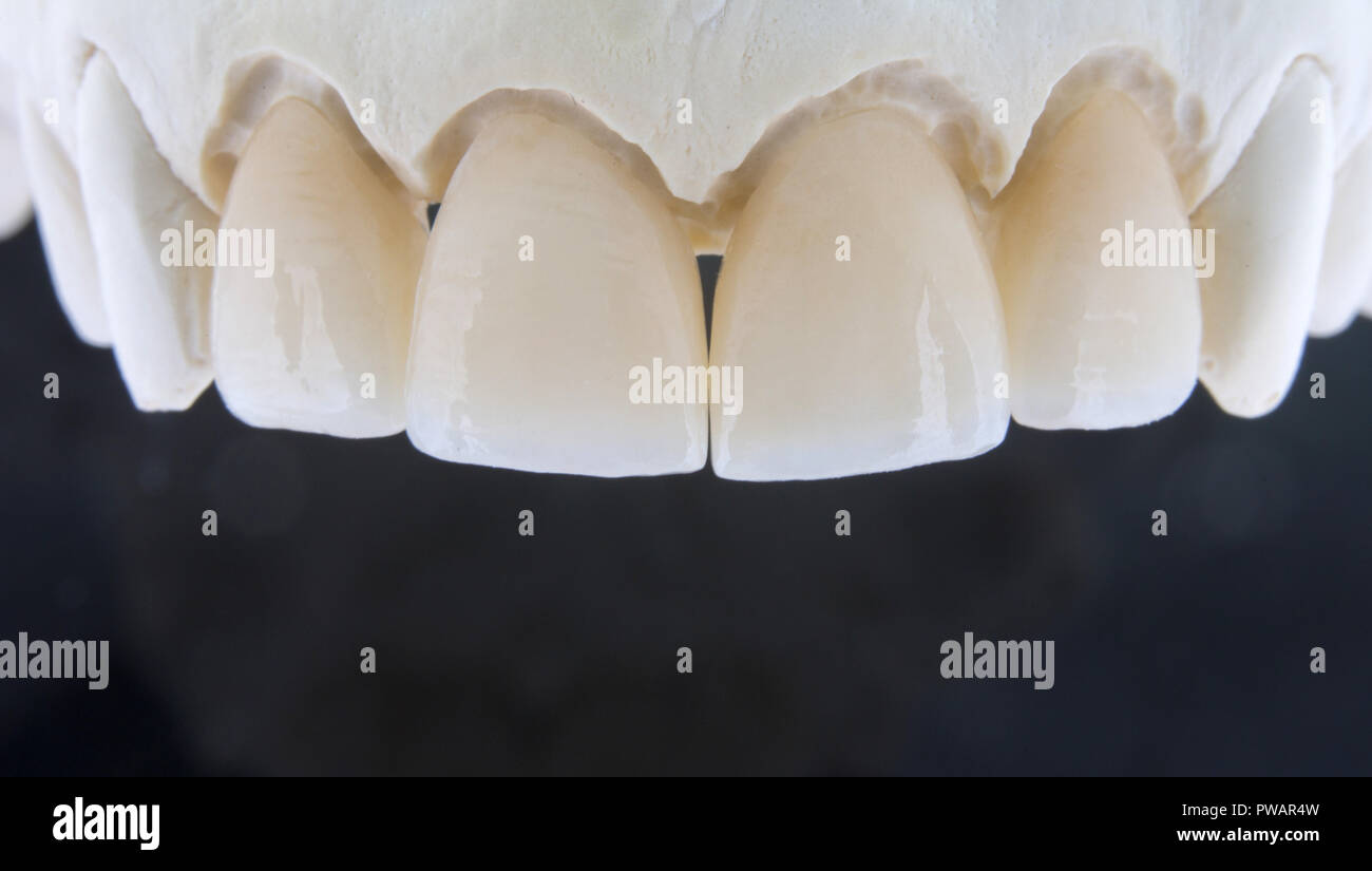 Ceramic teeth on a plaster model with a black background Stock Photo