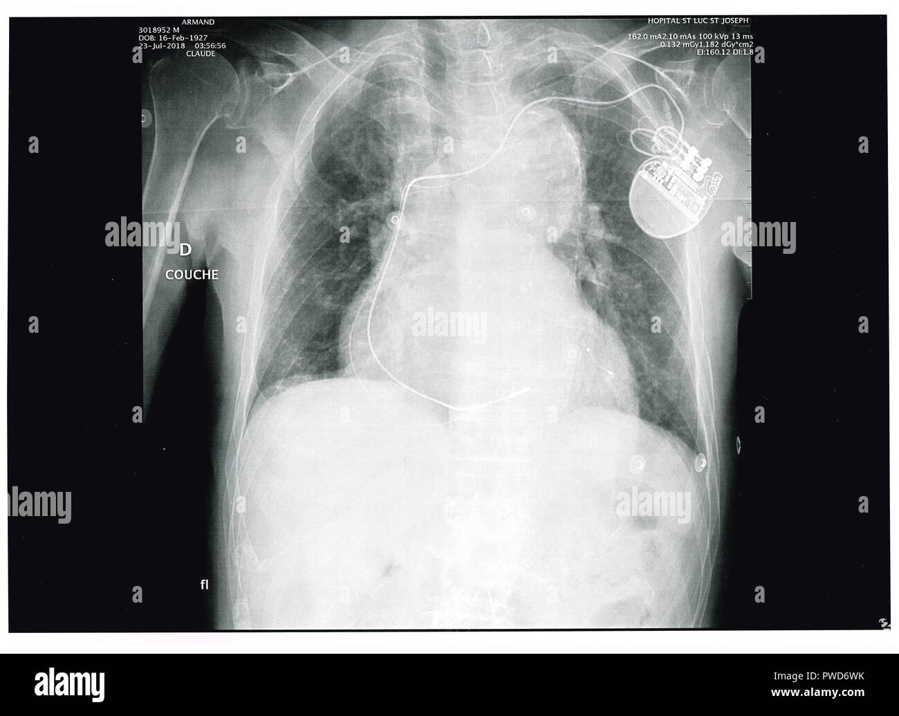 Pacemaker cardiaque hi-res stock photography and images - Alamy