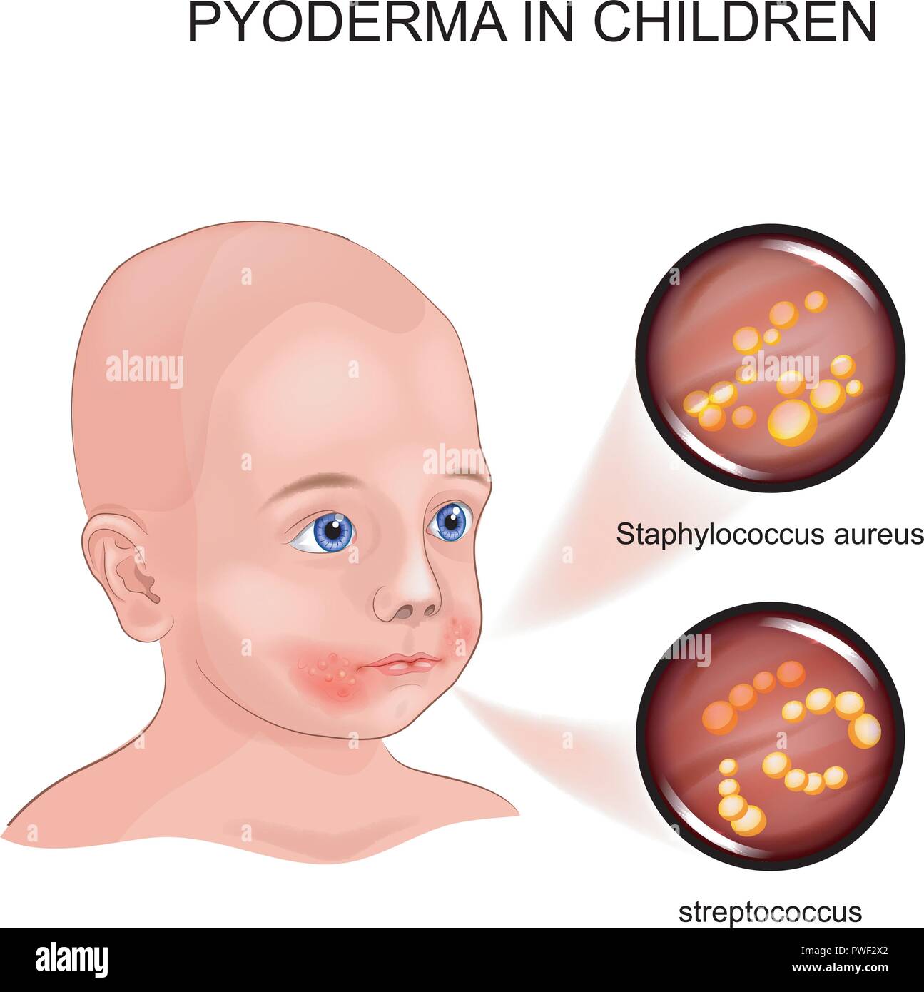 vector illustration in child pyoderma. Streptococcus, Staphylococcus Stock Vector