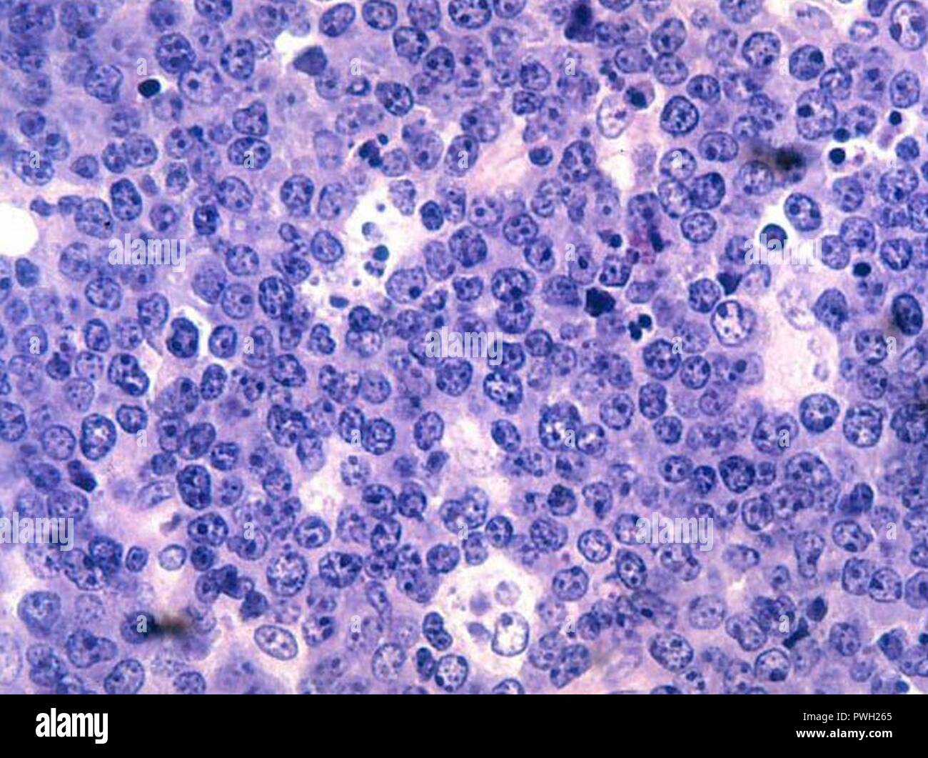 Burkitts lymphoma hi-res stock photography and images - Alamy