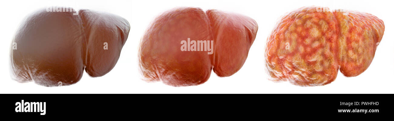 Realistic stages of a fatty liver - 3D Rendering Stock Photo