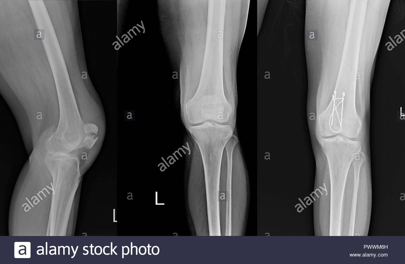 Normal Knee X Ray Stock Photos & Normal Knee X Ray Stock Images Alamy