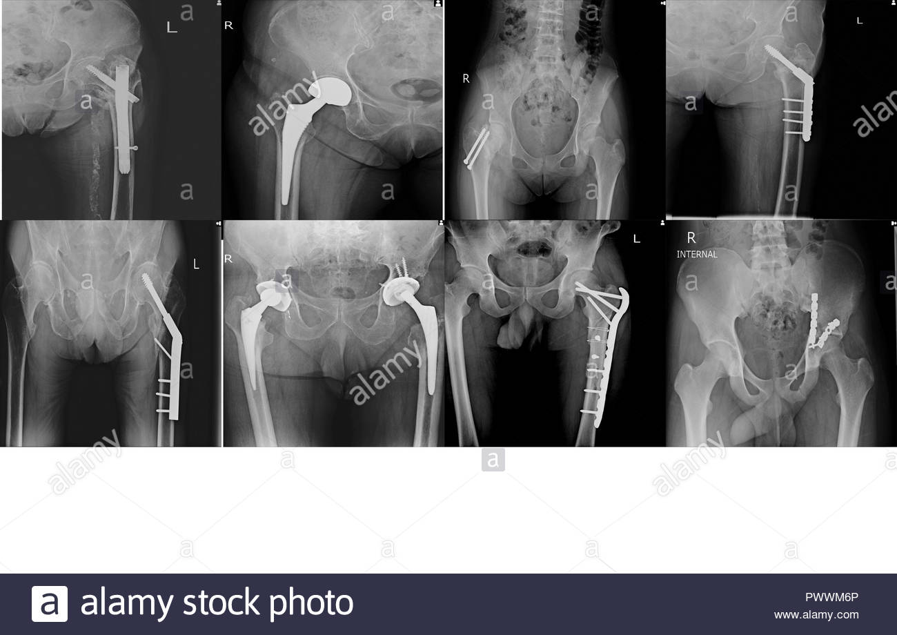 Orthopedic Hip Plate And Bone Screw Stock Photos & Orthopedic Hip Plate And Bone Screw Stock