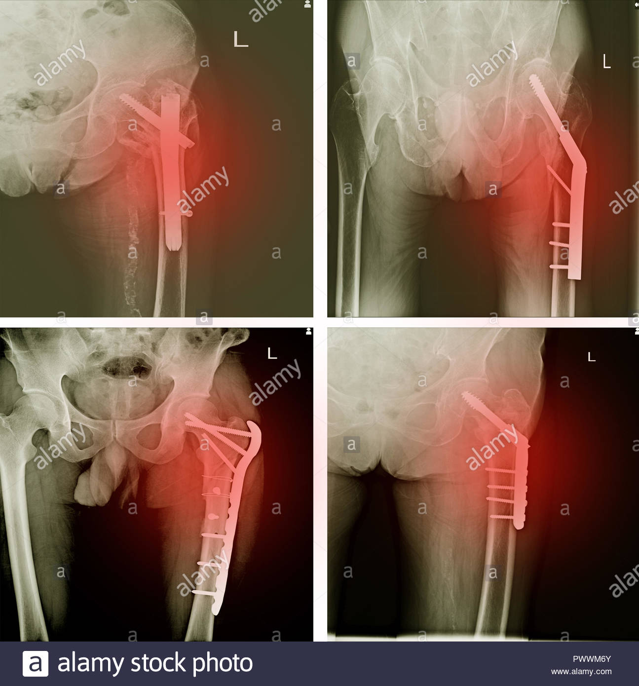 Orthopedic Hip Plate And Bone Screw Stock Photos & Orthopedic Hip Plate And Bone Screw Stock