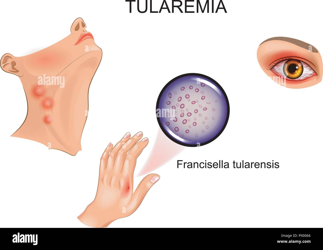 vector illustration of tularemia. hand bite. lymphadenitis and conjunctivitis Stock Vector