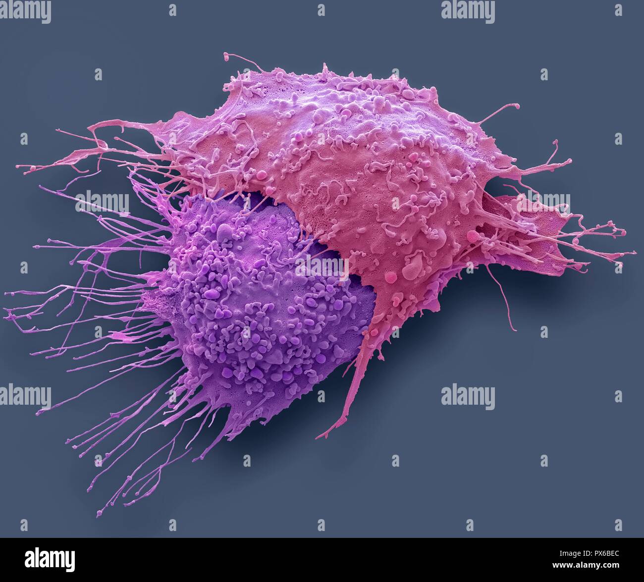 Ovarian cancer cells. Coloured scanning electron micrograph (SEM) of ovarian cancer cells. Cancer cells are typically large, have an irregular surface Stock Photo