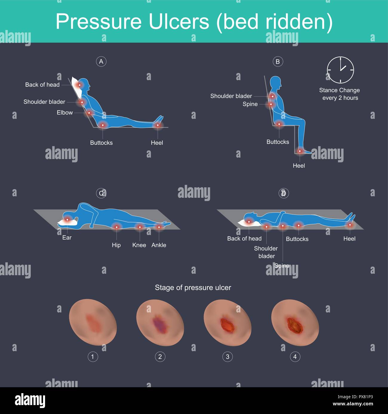 Pressure ulcers are injuries to the skin, primarily caused by prolonged pressure on the skin. They can happen to anyone, but usually affect people con Stock Vector