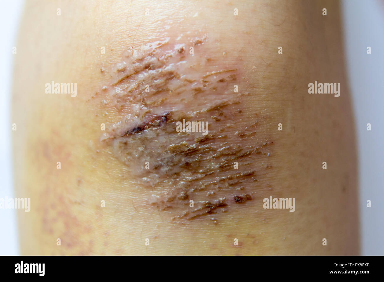 Closed up of red scab injury on woman knee background Stock Photo - Alamy