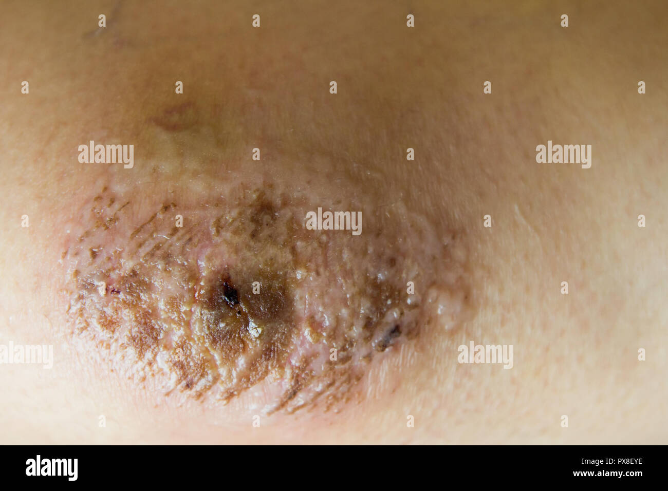 Closed up of red scab injury on woman knee background Stock Photo - Alamy