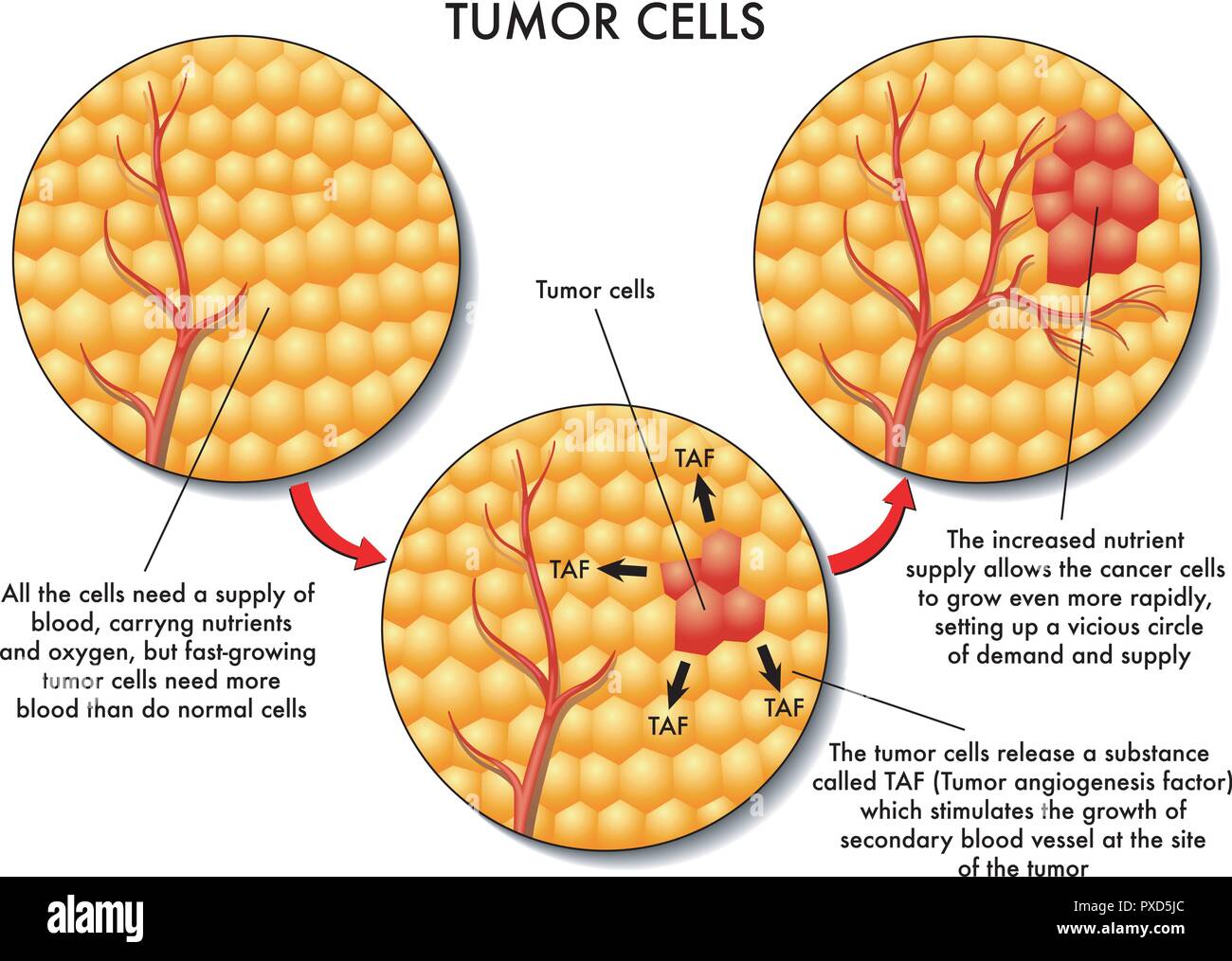 vector medical illustration of the formation of tumor cells Stock Vector