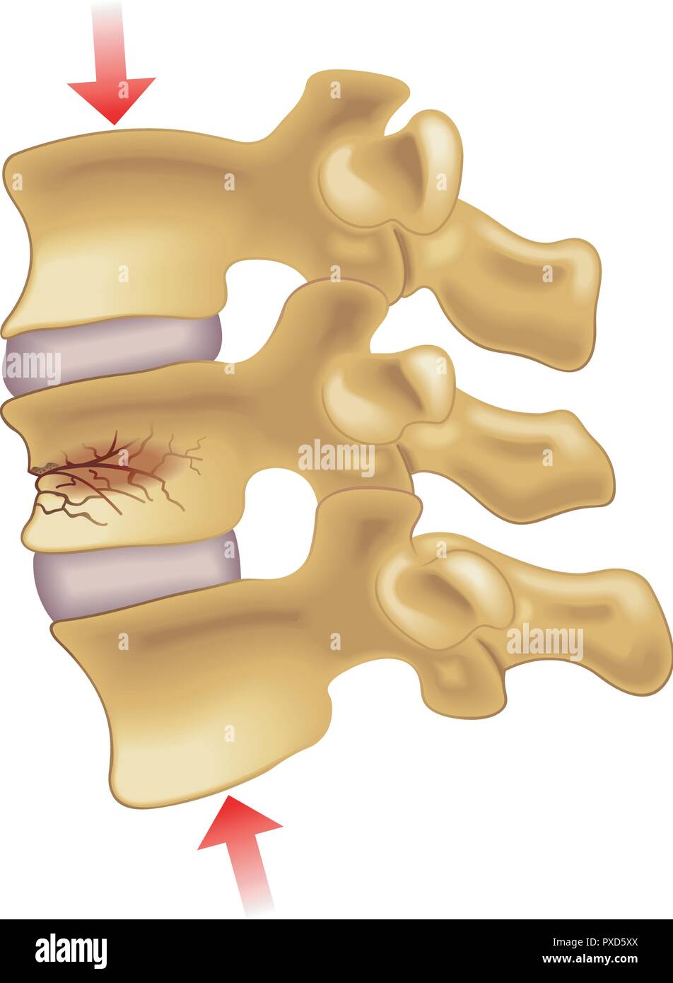 vector medical illustration of the symptoms of vertebral compression fracture Stock Vector