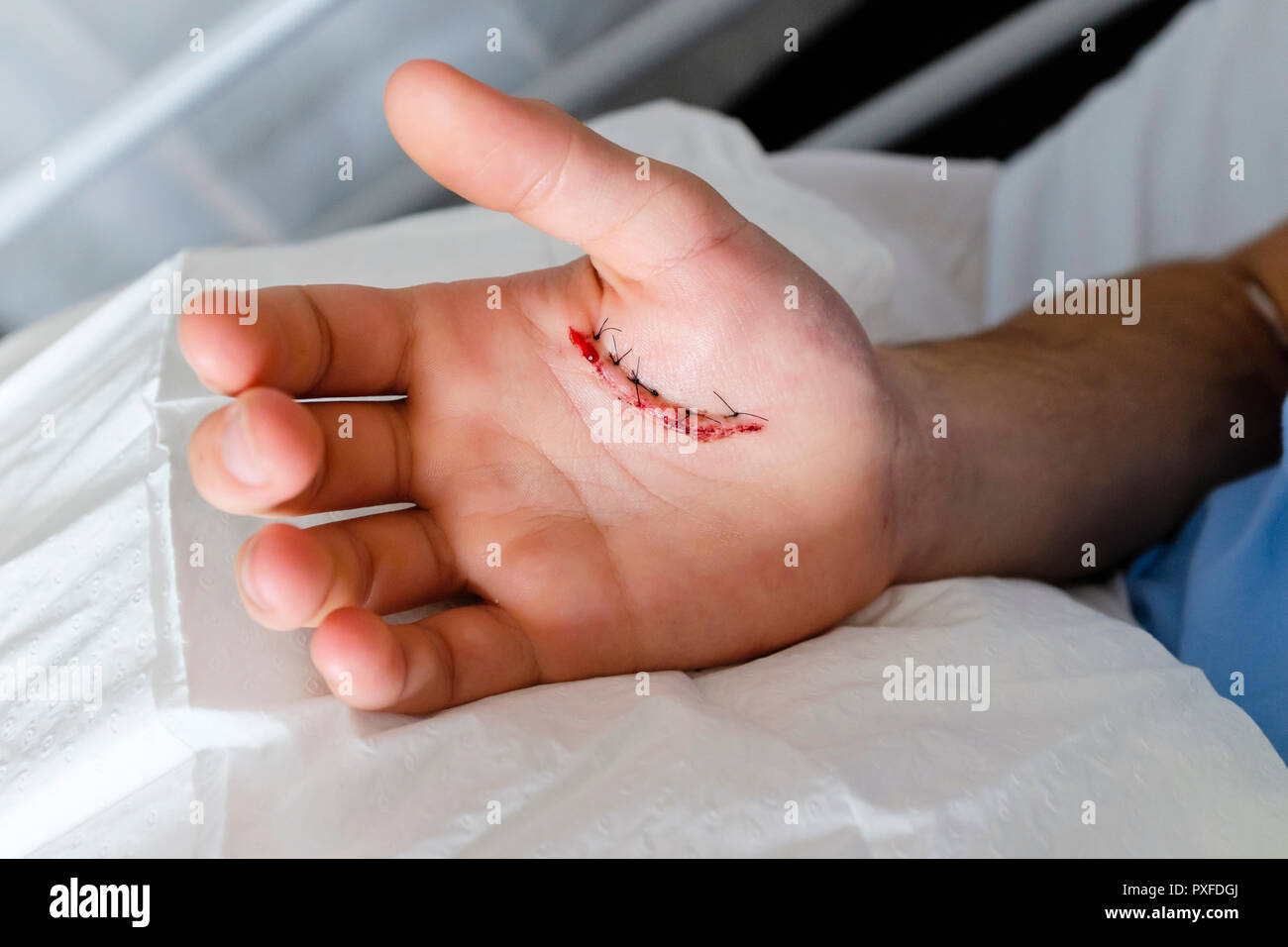 Patient with hand injury from dog bite that has stitches in hospital in Australia Oct 2018 Stock Photo