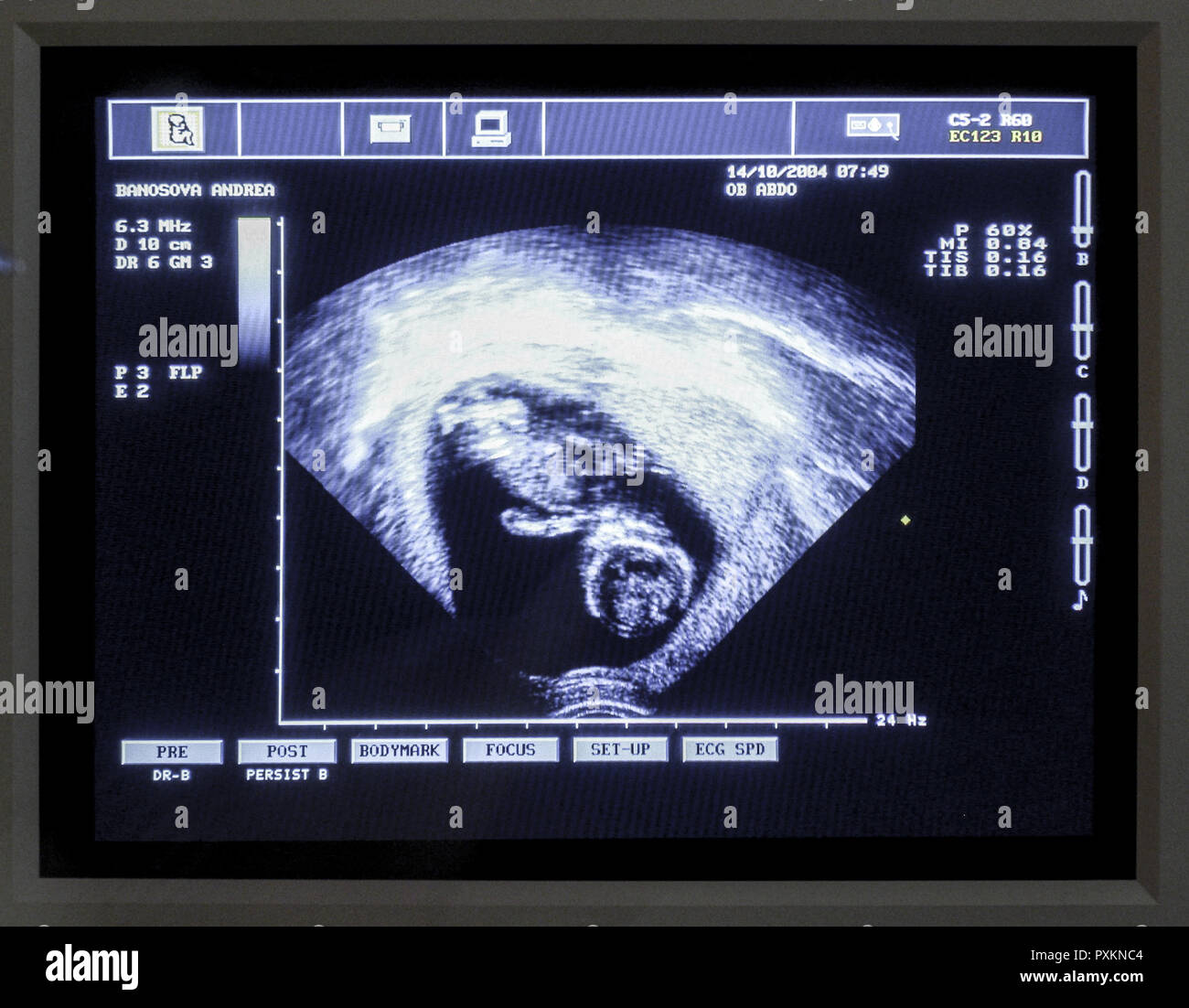 Ultraschallbild Foetus Monitor Untersuchung Schwangerschaft Kontrolluntersuchung Ultraschallaufnahme Kind Fetus Medizin Ultraschall Vorsorgeuntersuchu Stock Photo