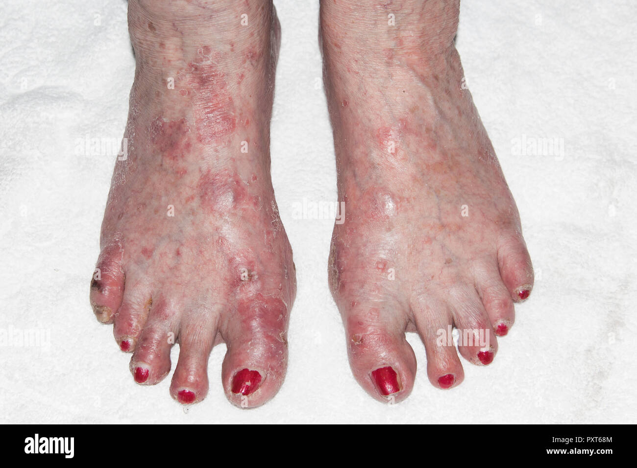 Patient with Atopic dermatitis or endogenous eczema, Germany Stock Photo
