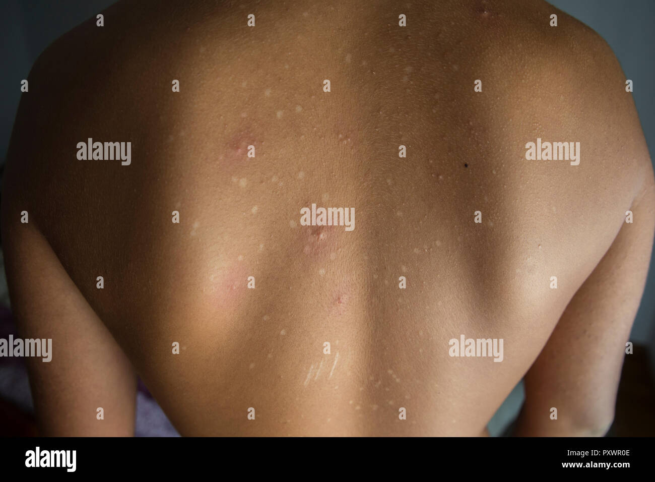 Psoriasis illness and autoimmune disease as dry red skin patches on a patient as a symbol for dermatology. Stock Photo