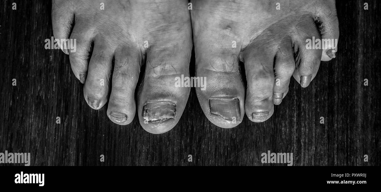 onychomycosis with fungal nail infection two feet. Stock Photo
