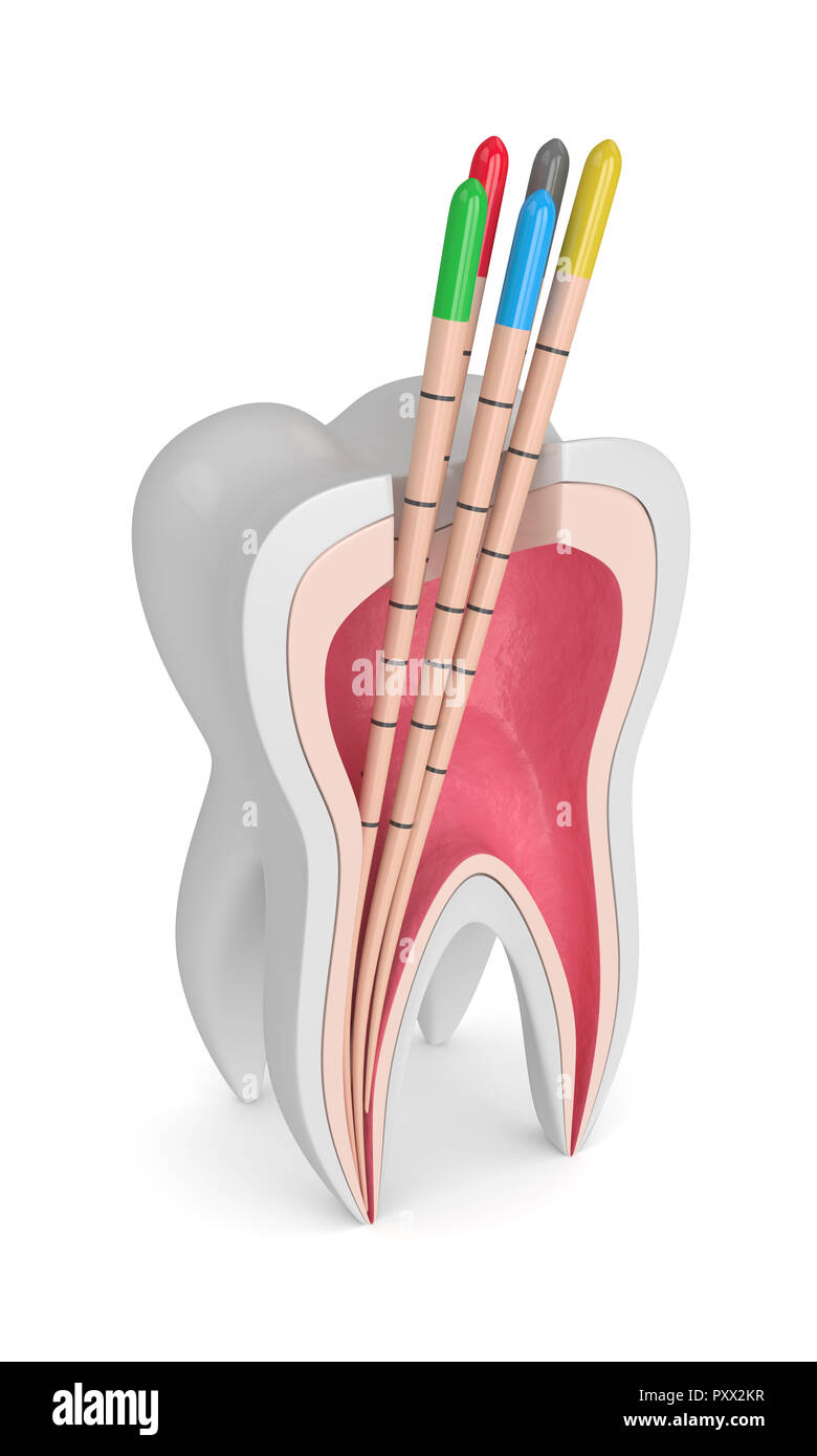 3d render of tooth with gutta percha over white background Stock Photo