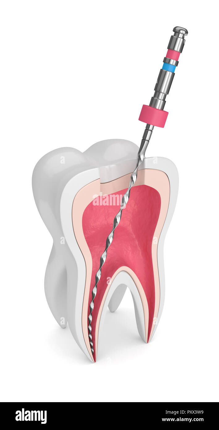 3d render of tooth with endodontic file over white background. Root canal treatment concept