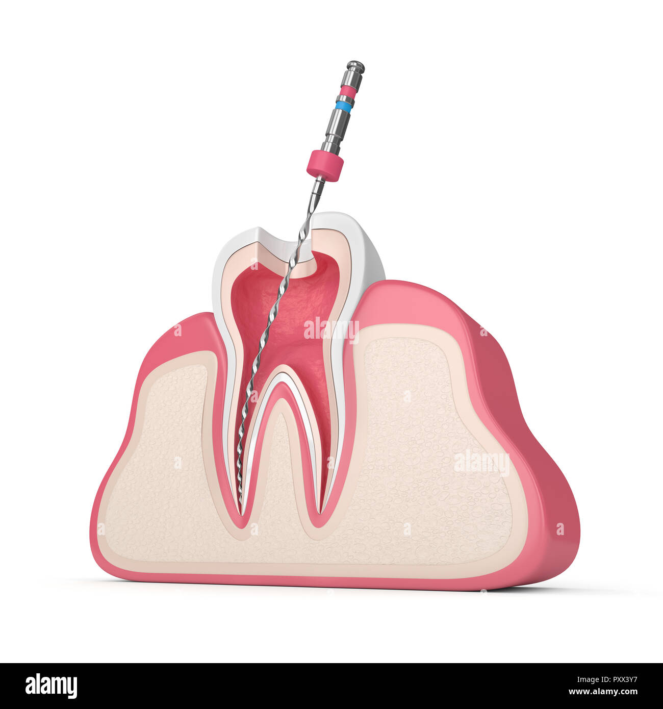 3d render of tooth with endodontic file in gums over white background