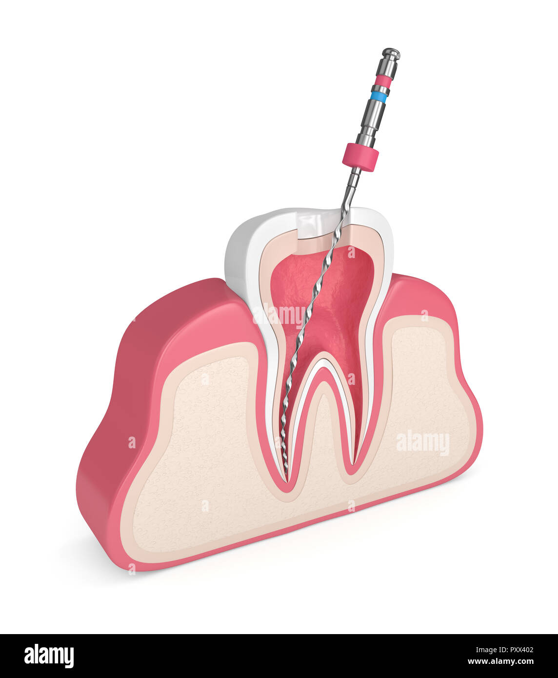 3d render of tooth with endodontic file in gums over white background