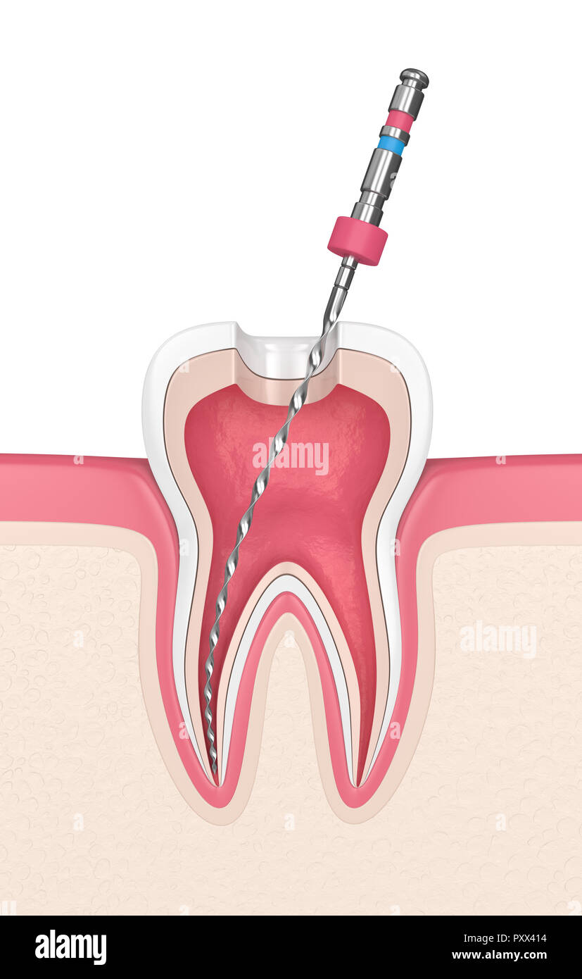 3d render of tooth with endodontic file in gums. Root canal treatment