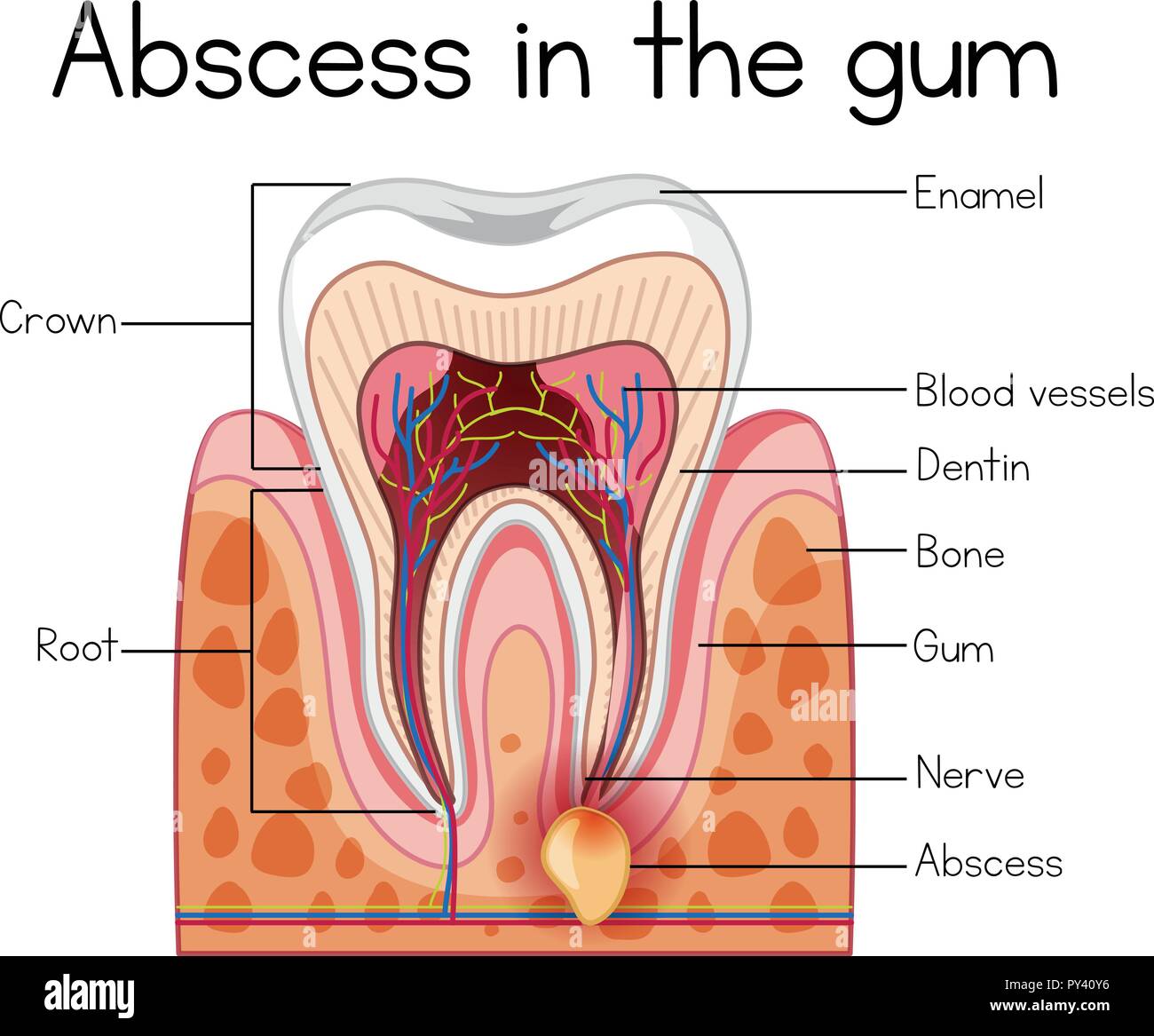 Abscess Parts Abscess in the Gum Diagram illustration Stock Vector Image & Art - Alamy