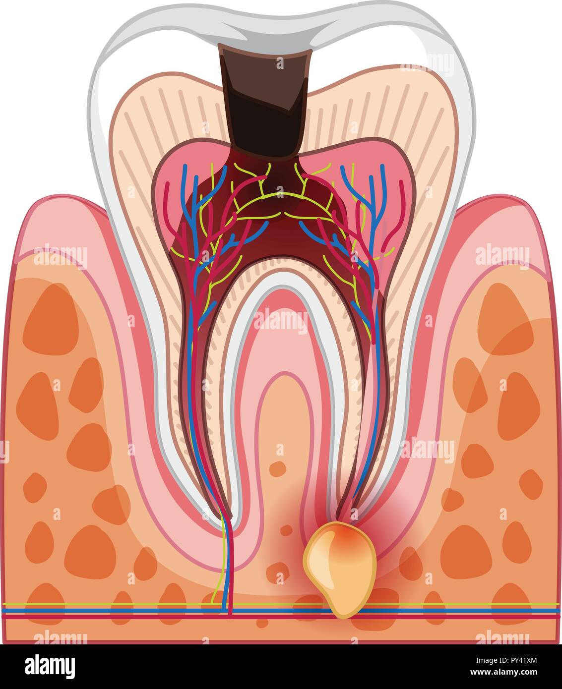 A Human Tooth Decay and Cavity illustration Stock Vector